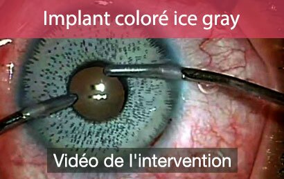 home-implant-colore-ice-gray