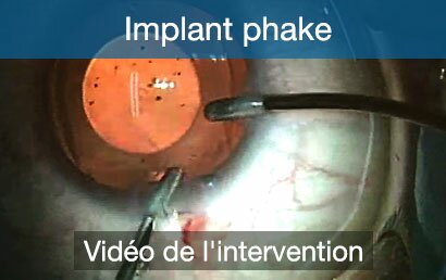 home-implant-phake